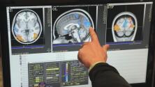 “Una luz al final del túnel”: medicamento experimental contra el Alzheimer logró reducir el deterioro cognitivo