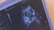Número de abortos en Estados Unidos aumenta pese a prohibiciones a nivel estatal, señala un estudio