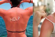 Recupera tu tono de piel: remedios eficaces para aclarar las quemaduras provocadas por el sol