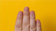 Tener hundimientos en las uñas puede ser señal de diabetes y otros problemas de salud