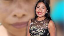 Yalitza Aparicio padece melasma, una enfermedad de la piel incurable y que confundió con acné