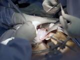 Sale del hospital la primera persona en recibir un trasplante de riñón de un cerdo 