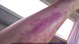 Mujer se infectó con bacteria 'come carne' en playa de Florida: por qué no debes bañarte en el mar con heridas abiertas